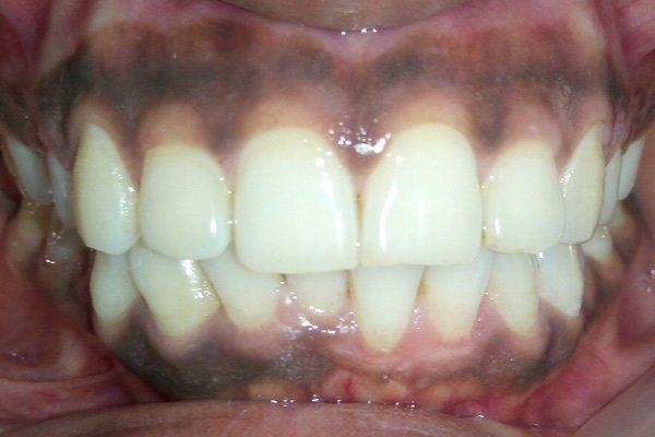 depigmentation