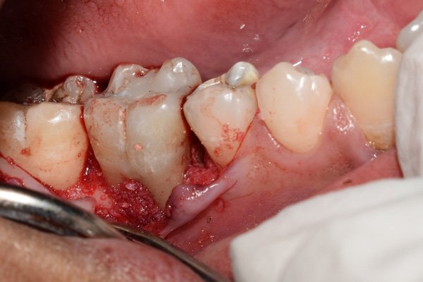 furcation